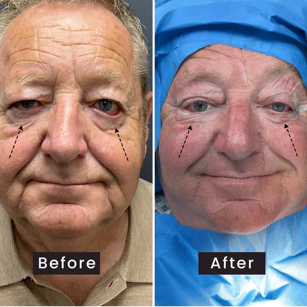 Ectropion Surgery Before and After Comparison